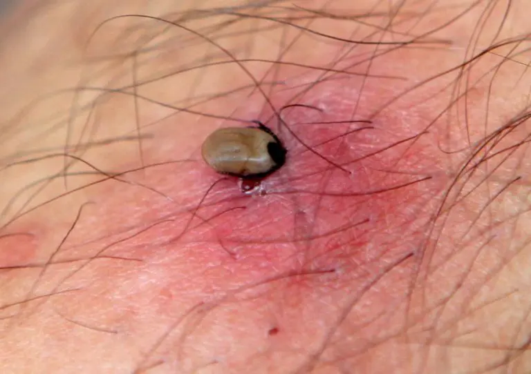 Kako pravilno izvaditi krpelja?