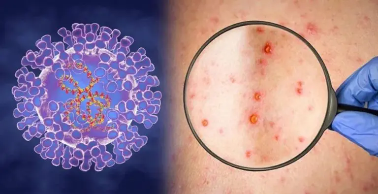 WHO: Epidemija majmunskih boginja usporava u Evropi