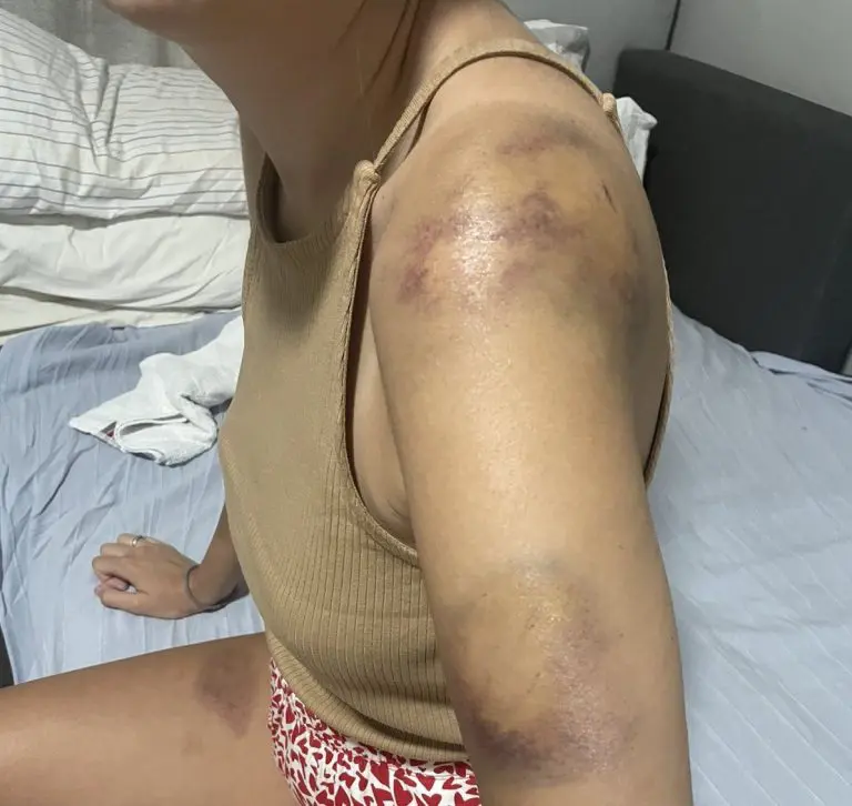 Ivani je grad napravio modrice po cijelom tijelu: “Mislila sam da neću preživjeti”