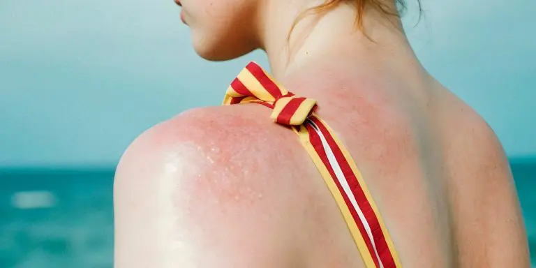 Savjeti iz Hemofarma: Znate li šta je solarna urtikarija?